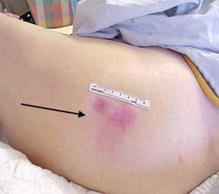 Stage 1 pressure ulcer, pale complexion.